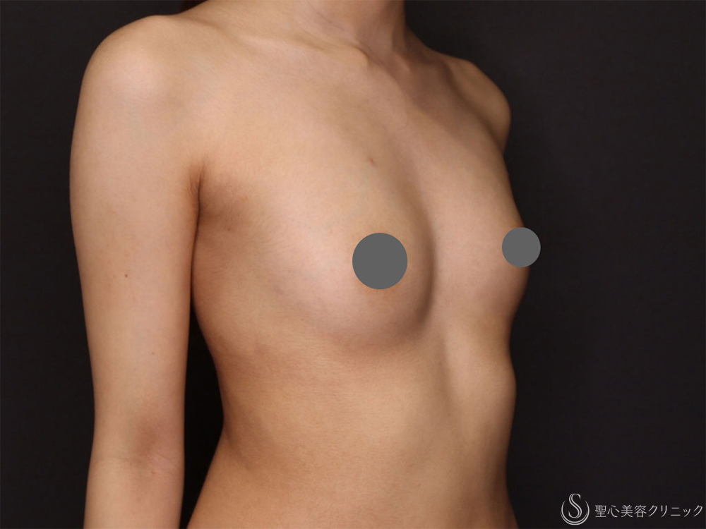 【20代女性・体型にあった自然なサイズアップ】バッグによる豊胸術（MotivaErgonomix2 180cc）（3ヶ月後） Before 