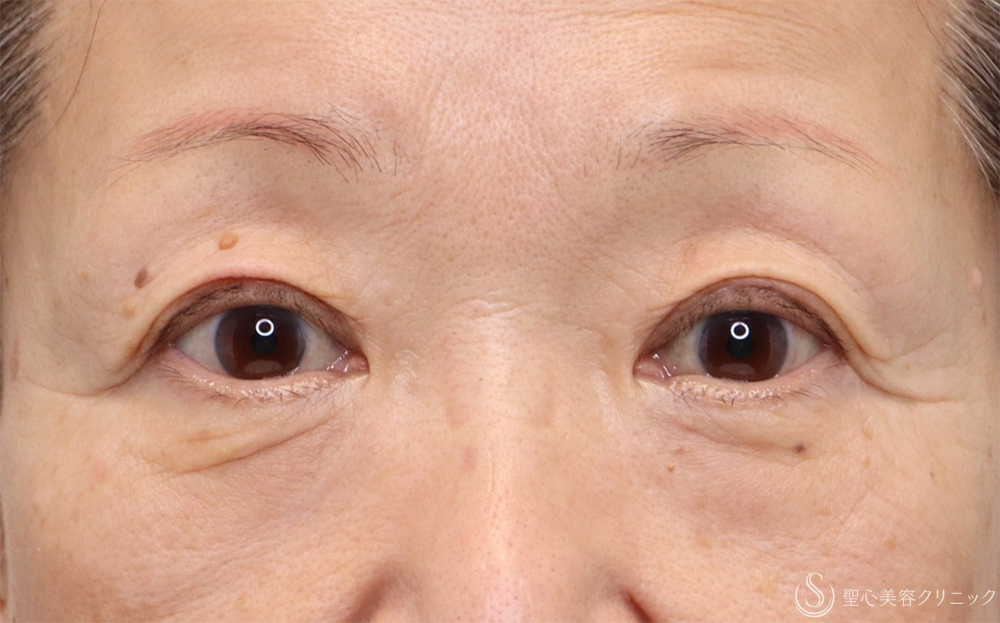 【60代女性・自然にすっきりと】眉下切開（3ヶ月後） Before 