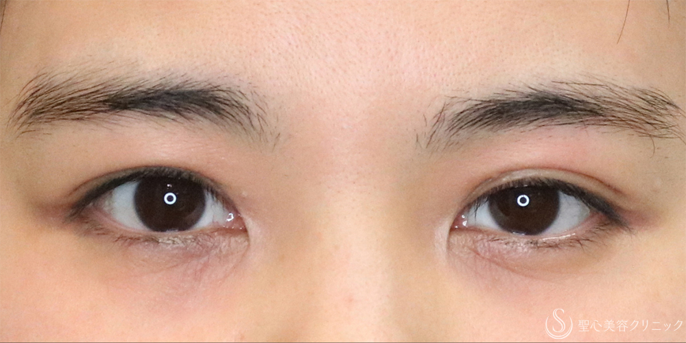 【30代女性・二重の左右差を揃える】目の上のたるみ取り（左のみ）（1ヶ月後） Before 