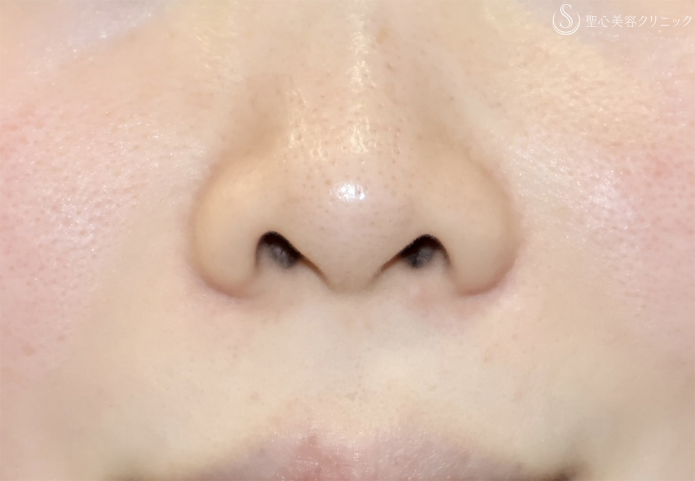 【30代女性・鼻の穴が見えるのが気になる】鼻孔縁下降術（1ヶ月後） Before 