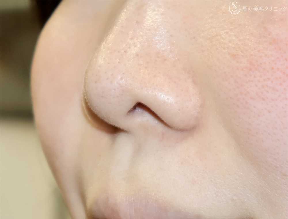 【30代女性・鼻の穴が見えるのが気になる】鼻孔縁下降術（1ヶ月後） Before 