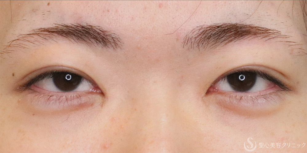 【20代男性・左右差を整え自然な二重に】二重埋没法（マイクロメソッド+α）（1ヶ月後） After 