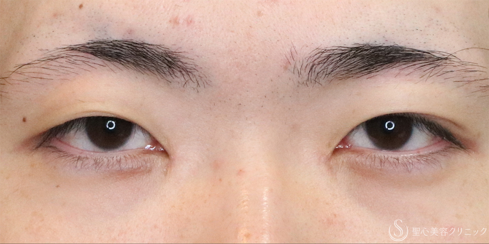 【20代男性・左右差を整え自然な二重に】二重埋没法（マイクロメソッド+α）（1ヶ月後） Before 
