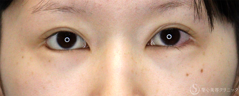 【20代女性・他院垂れ目形成後の修正】たれ目形成（グラマラスライン／下眼瞼下制術）（切開法）（1ヶ月後） Before 