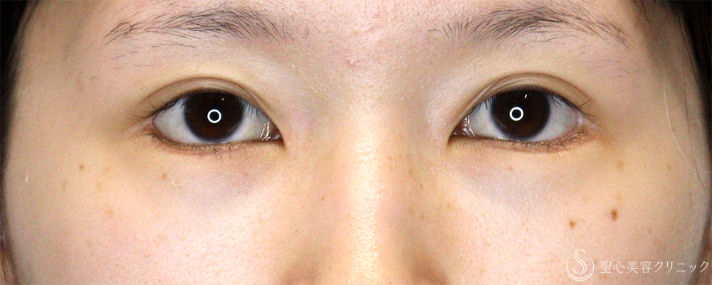【20代女性・他院垂れ目形成後の修正】たれ目形成（グラマラスライン／下眼瞼下制術）（切開法）（1ヶ月後） After 