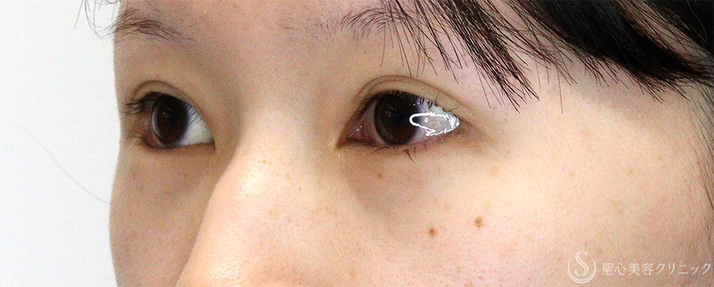 【20代女性・他院垂れ目形成後の修正】たれ目形成（グラマラスライン／下眼瞼下制術）（切開法）（1ヶ月後） Before 