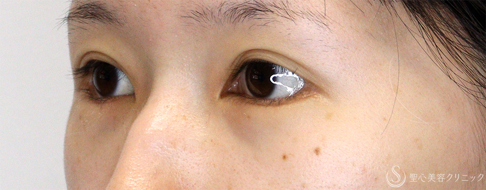 【20代女性・他院垂れ目形成後の修正】たれ目形成（グラマラスライン／下眼瞼下制術）（切開法）（1ヶ月後） After 
