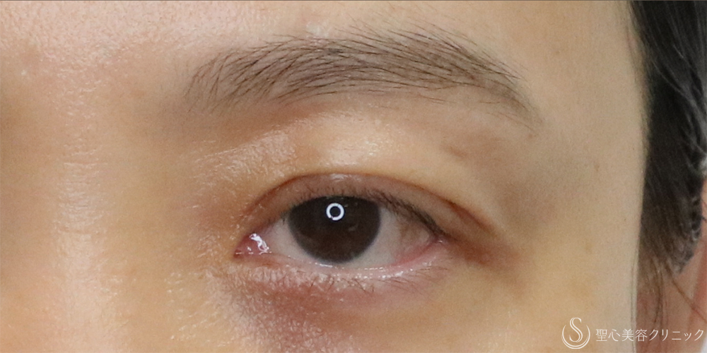 【40代女性・切らずに目の開き改善】眼瞼下垂埋没法（左のみ）（1ヶ月後） After 