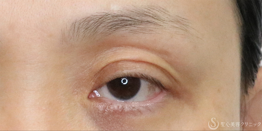 【40代女性・切らずに目の開き改善】眼瞼下垂埋没法（左のみ）（1ヶ月後） Before 