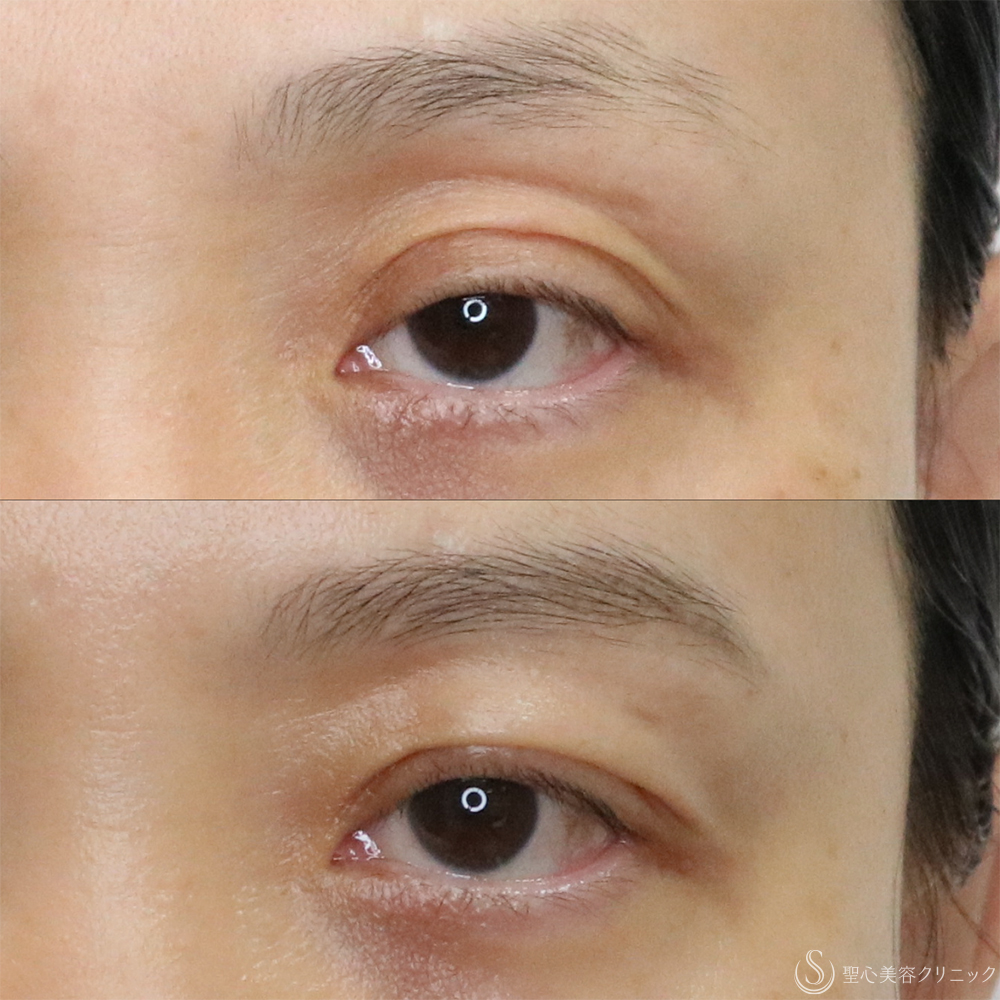 【40代女性・切らずに目の開き改善】眼瞼下垂埋没法（左のみ）（1ヶ月後） After 名古屋+眼瞼下垂　埋没法