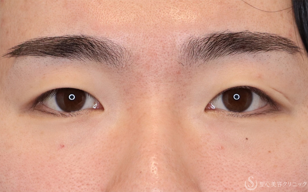 【20代男性・目力アップ】二重埋没法：ダブルノット法（1ヶ月後） Before 