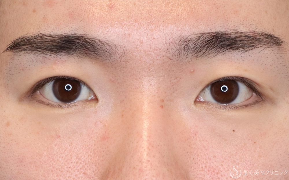 【20代男性・目力アップ】二重埋没法：ダブルノット法（1ヶ月後） After 