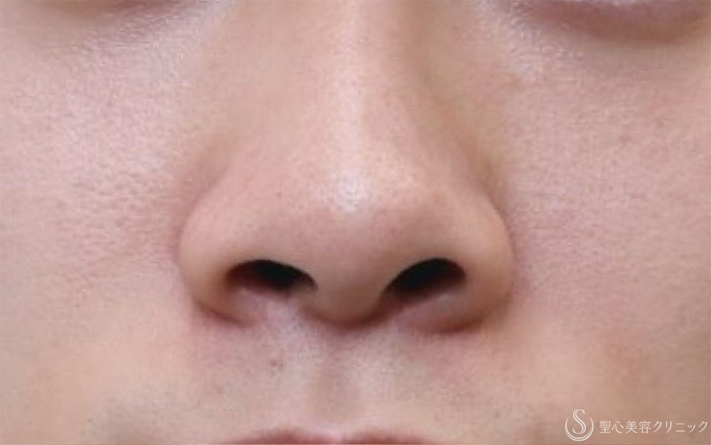 【20代男性・小鼻の大きさが気になる】小鼻縮小（1ヶ月後） Before 