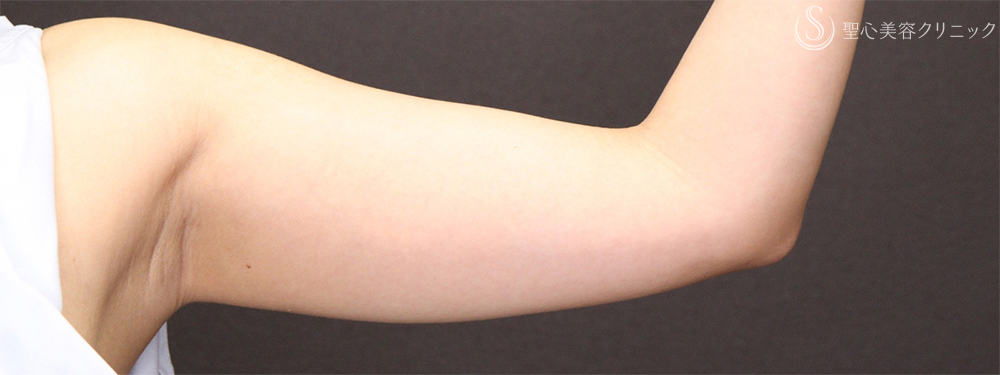 【30代女性・細い腕で華奢な印象に】二の腕ベイザー脂肪吸引後（3ヶ月後） Before 
