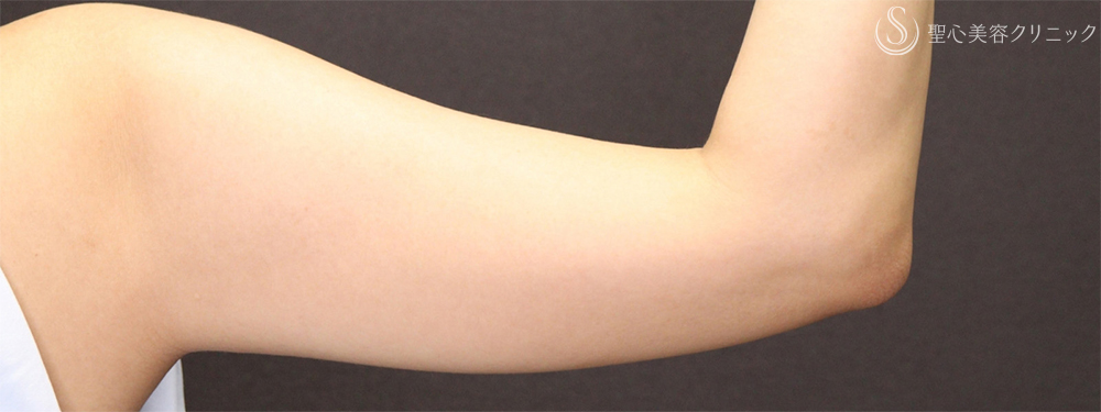 【30代女性・細い腕で華奢な印象に】二の腕ベイザー脂肪吸引後（3ヶ月後） Before 