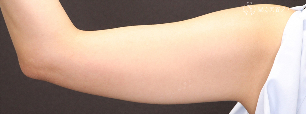 【30代女性・細い腕で華奢な印象に】二の腕ベイザー脂肪吸引後（3ヶ月後） Before 