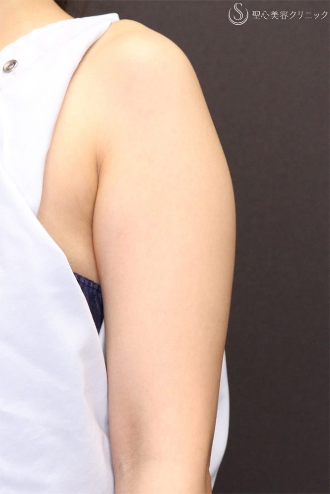 【30代女性・細い腕で華奢な印象に】二の腕ベイザー脂肪吸引後（3ヶ月後） Before 