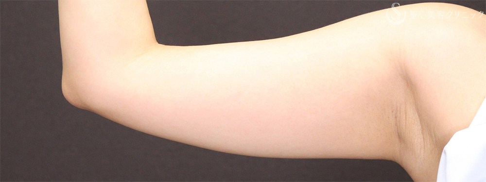 【30代女性・細い腕で華奢な印象に】二の腕ベイザー脂肪吸引後（3ヶ月後） Before 