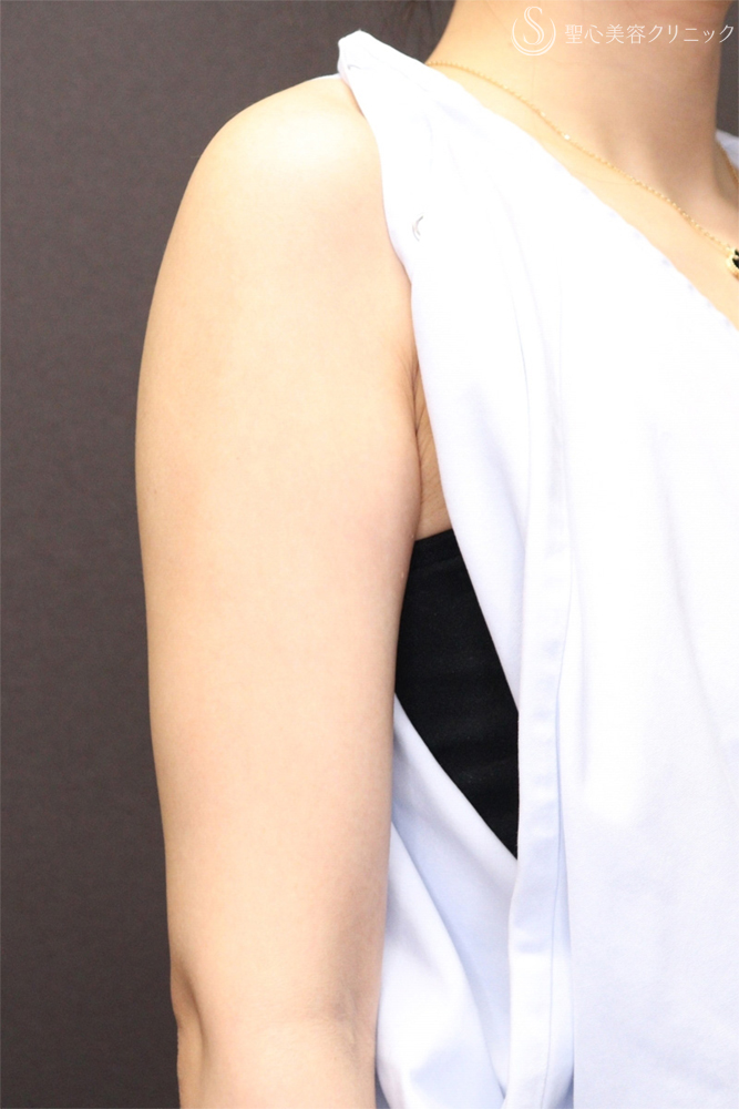 【30代女性・細い腕で華奢な印象に】二の腕ベイザー脂肪吸引後（3ヶ月後） After 