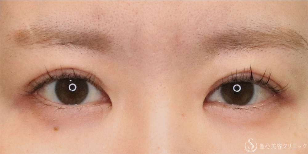 【30代女性・ナチュラルな二重で目元の印象アップ】二重埋没法（マイクロメソッド＋α）（1ヶ月後） After 