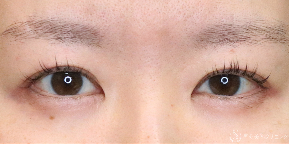 【30代女性・ナチュラルな二重で目元の印象アップ】二重埋没法（マイクロメソッド＋α）（1ヶ月後） Before 