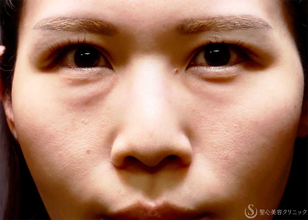 【30代女性・目の下のクマ】裏ハムラ法（直後・7日後） Before 