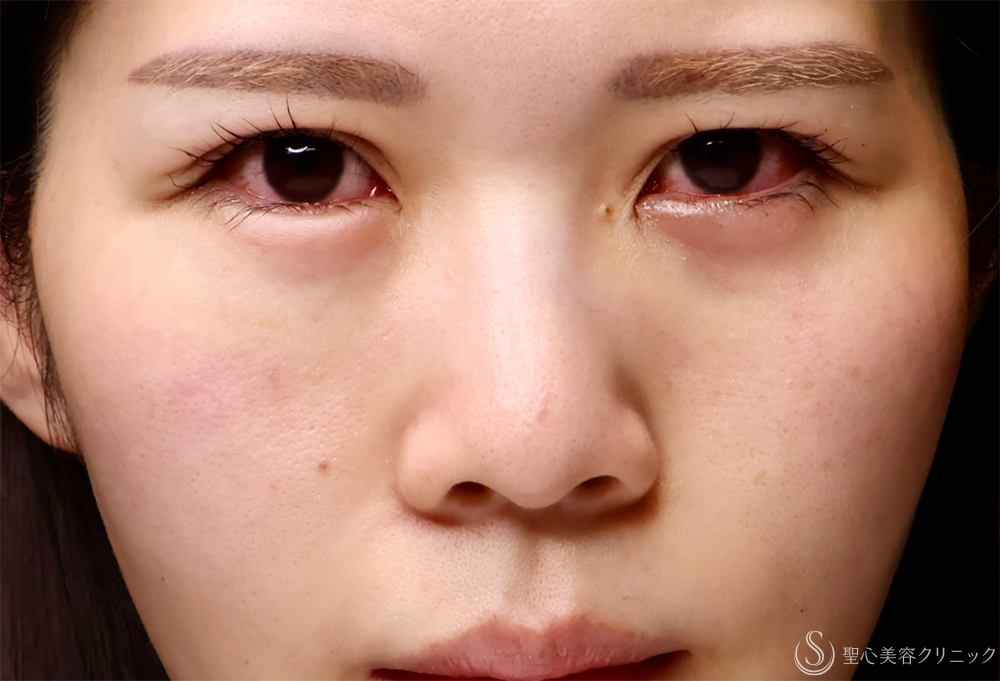 【30代女性・目の下のクマ】裏ハムラ法（直後・7日後） After 