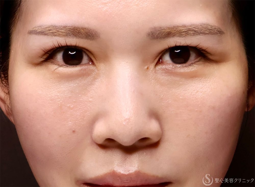 【30代女性・目の下のクマ】裏ハムラ法（直後・7日後） After 