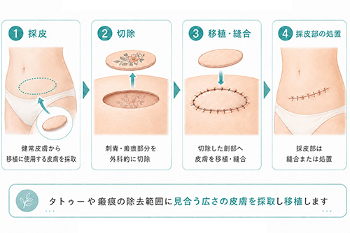 植皮術による刺青除去