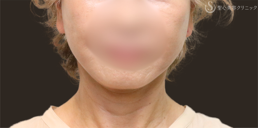 【70代女性・フェイスラインをすっきり】フェイスリフト＋脂肪吸引（頬＋顎下）＋リガメント処理（1ヶ月後） After 