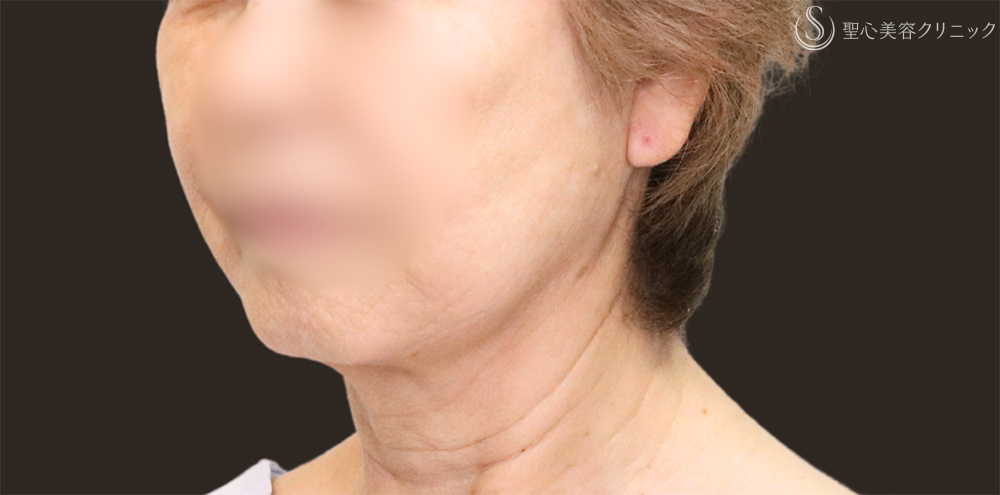 【70代女性・フェイスラインをすっきり】フェイスリフト＋脂肪吸引（頬＋顎下）＋リガメント処理（1ヶ月後） Before 