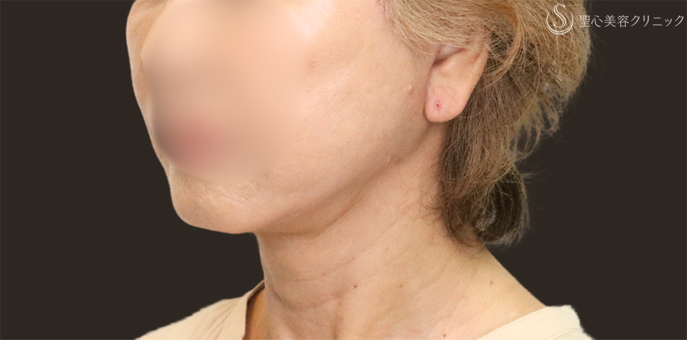 【70代女性・フェイスラインをすっきり】フェイスリフト＋脂肪吸引（頬＋顎下）＋リガメント処理（1ヶ月後） After 