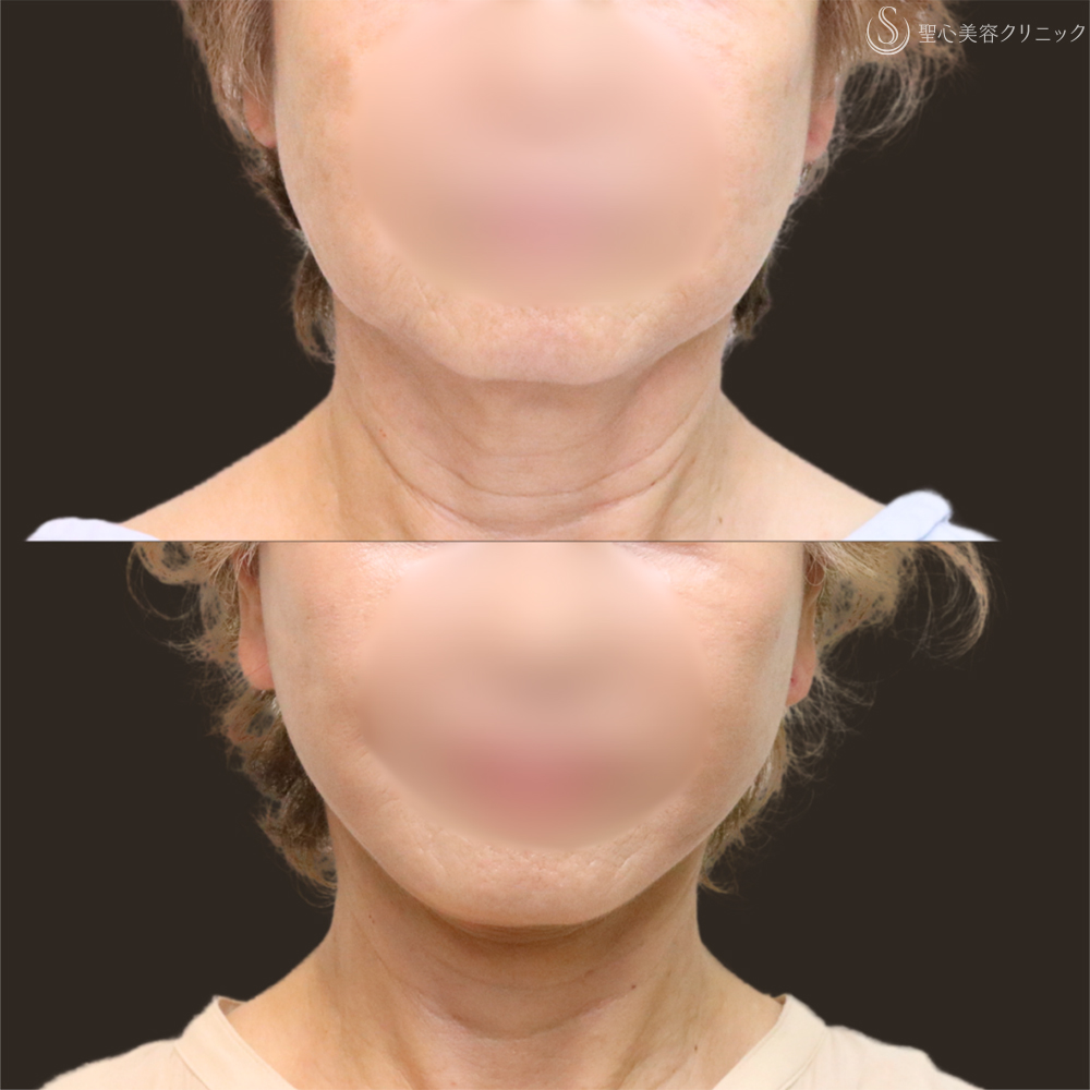 【70代女性・フェイスラインをすっきり】フェイスリフト＋脂肪吸引（頬＋顎下）＋リガメント処理（1ヶ月後） After 名古屋+フェイスリフト　たるみ　脂肪吸引　若返り