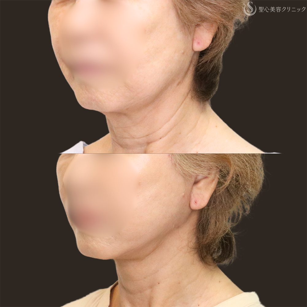 【70代女性・フェイスラインをすっきり】フェイスリフト＋脂肪吸引（頬＋顎下）＋リガメント処理（1ヶ月後） After 名古屋+フェイスリフト　たるみ　脂肪吸引　若返り