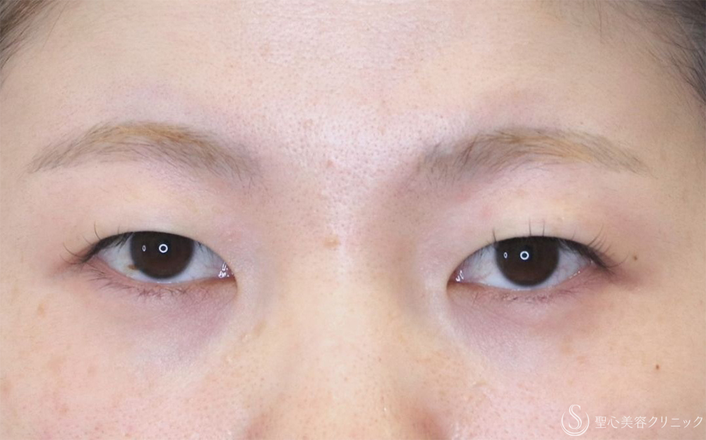 【20代女性・皮膚の重さを改善】二重切開（1ヶ月後） Before 