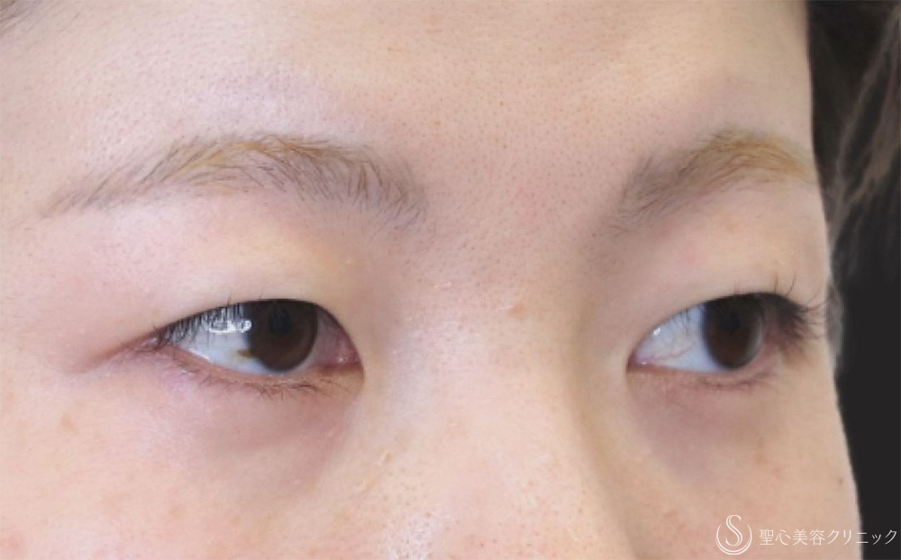 【20代女性・皮膚の重さを改善】二重切開（1ヶ月後） Before 