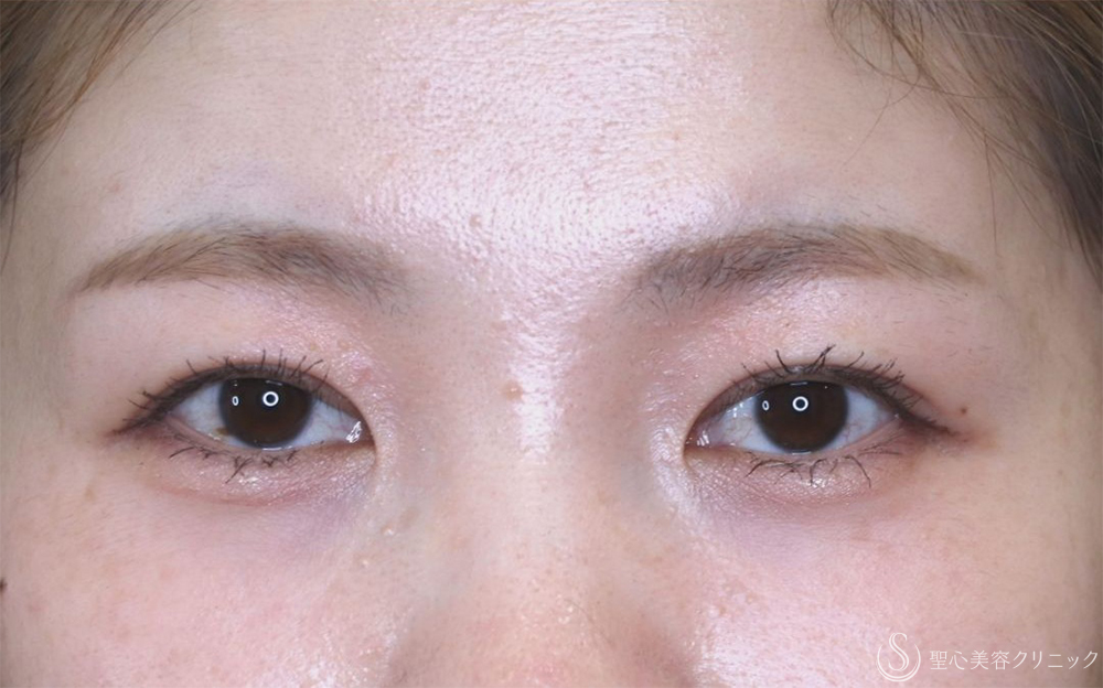 【20代女性・皮膚の重さを改善】二重切開（1ヶ月後） After 