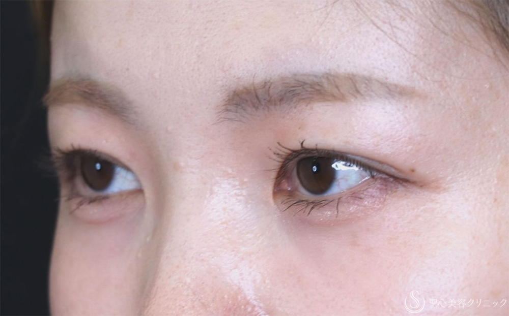 【20代女性・皮膚の重さを改善】二重切開（1ヶ月後） After 