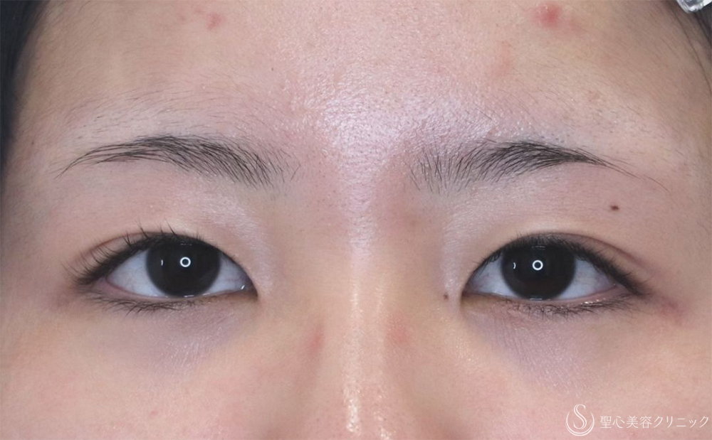 【20代女性・ハッキリとした二重に】二重切開（1ヶ月後） Before 