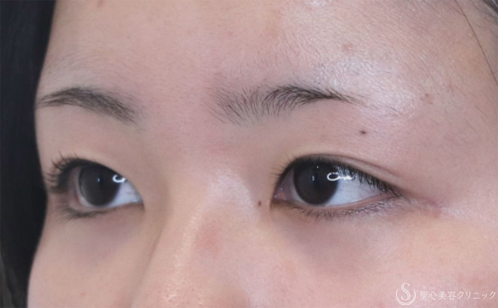 【20代女性・ハッキリとした二重に】二重切開（1ヶ月後） Before 