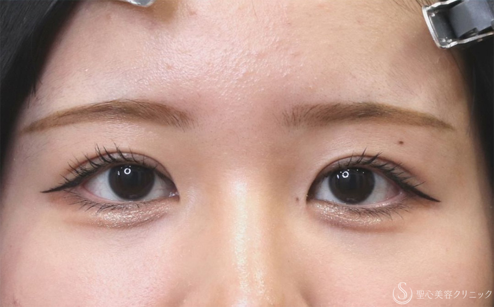 【20代女性・ハッキリとした二重に】二重切開（1ヶ月後） After 
