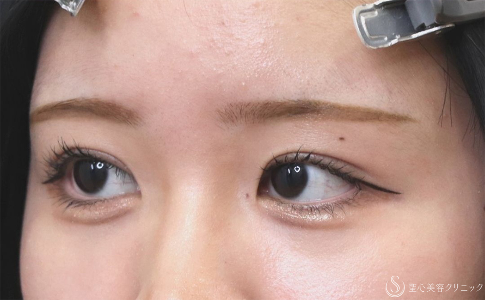 【20代女性・ハッキリとした二重に】二重切開（1ヶ月後） After 