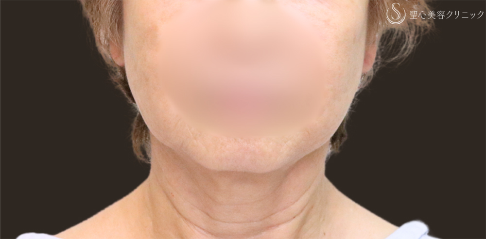 【70代女性・フェイスラインをすっきり】フェイスリフト＋脂肪吸引（頬＋顎下）＋リガメント処理（1ヶ月後） Before 