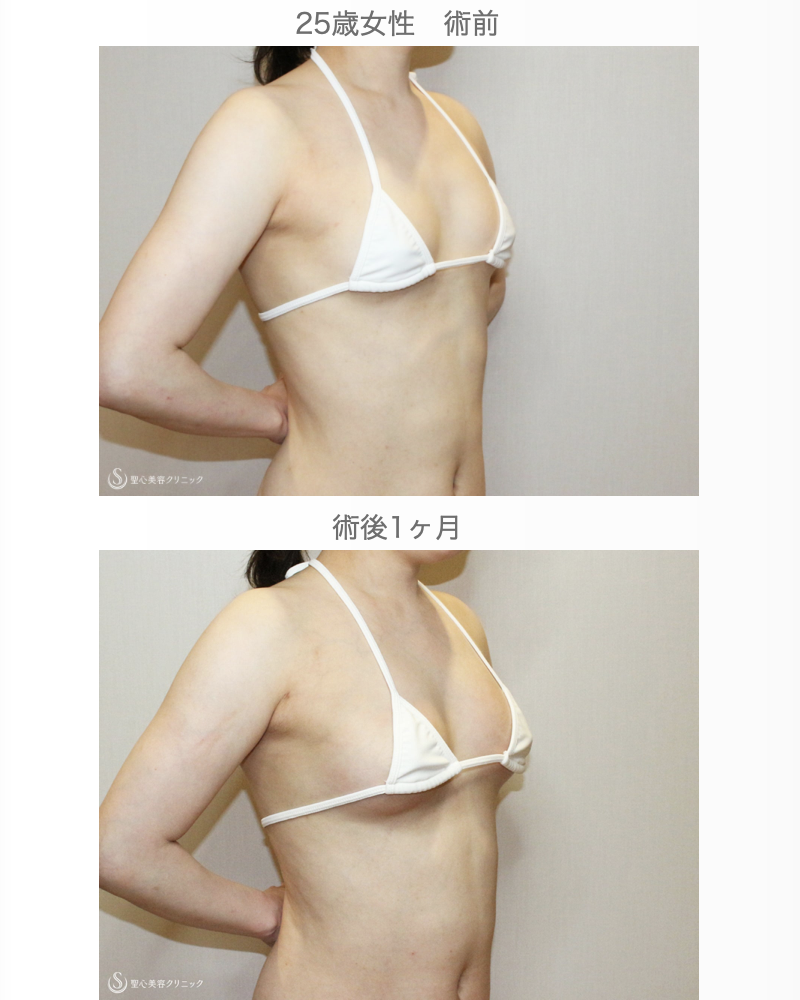 【25歳女性・繊維質の脂肪で吸引に苦労したケース】プレミアムセリューション豊胸術（1ヶ月後） After 