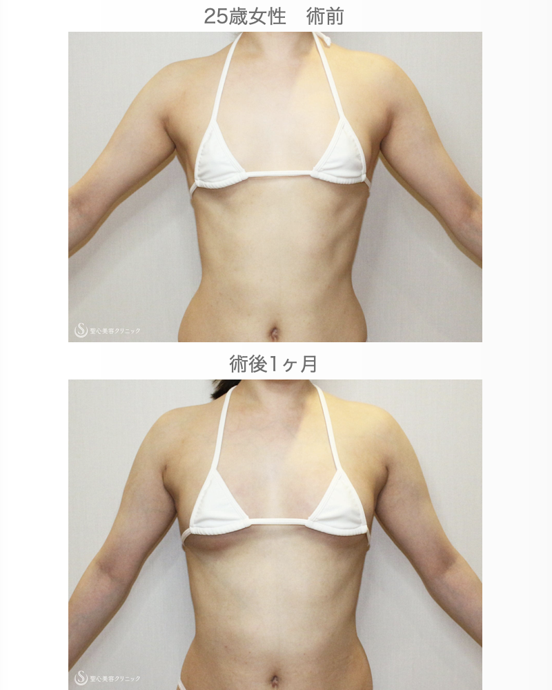 【25歳女性・繊維質の脂肪で吸引に苦労したケース】プレミアムセリューション豊胸術（1ヶ月後） After 