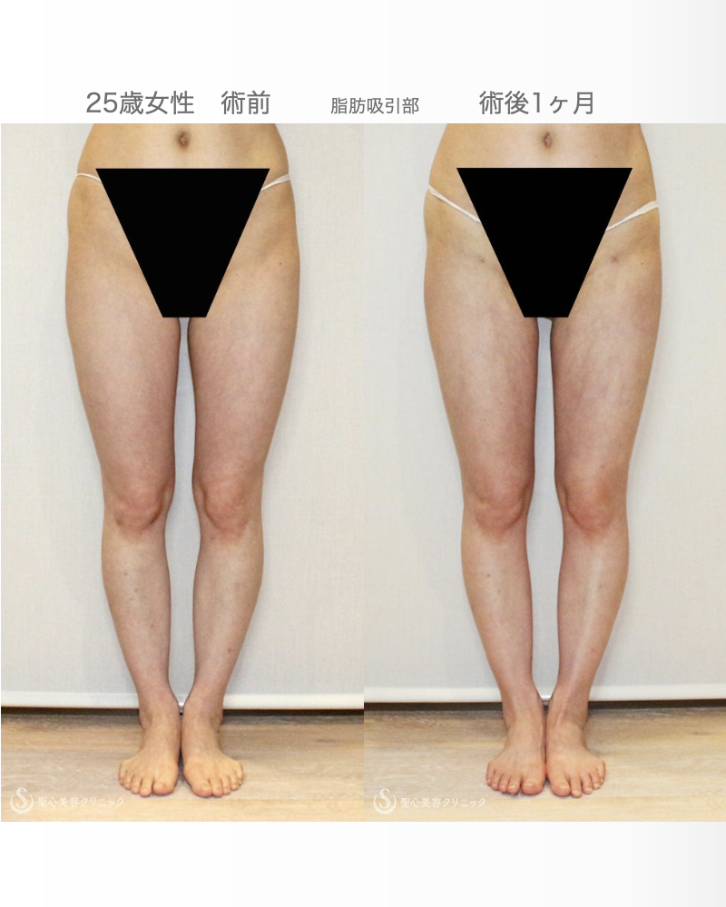 【25歳女性・繊維質の脂肪で吸引に苦労したケース】プレミアムセリューション豊胸術（1ヶ月後） After 