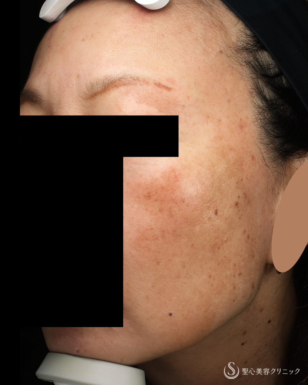 【50代女性・肌質色】スキンケア見直しとダーマセプト外用（2ヶ月後） Before 