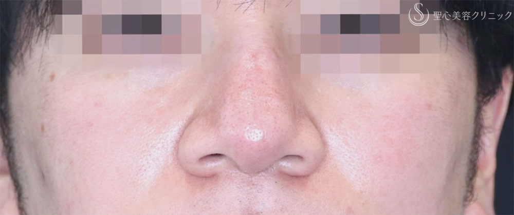 【30代男性・広い横幅を狭く】小鼻縮小（内外法）（1週間と1ヶ月後） Before 