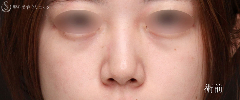 【20代女性・鼻先をスッキリ整える】鼻尖縮小＋鼻尖形成（耳介軟骨移植術）（1ヶ月後） Before 