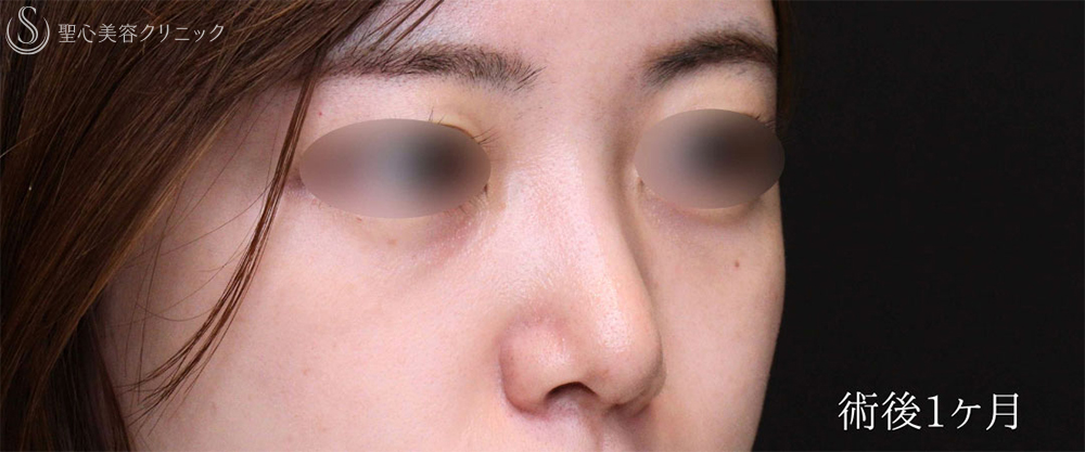 【20代女性・鼻先をスッキリ整える】鼻尖縮小＋鼻尖形成（耳介軟骨移植術）（1ヶ月後） After 